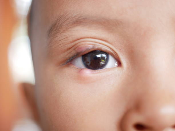 Meibomian Gland Dysfunction